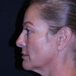 Facelift Before & After Patient #11558