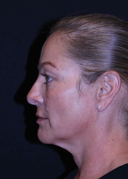 Facelift Before & After Patient #11558