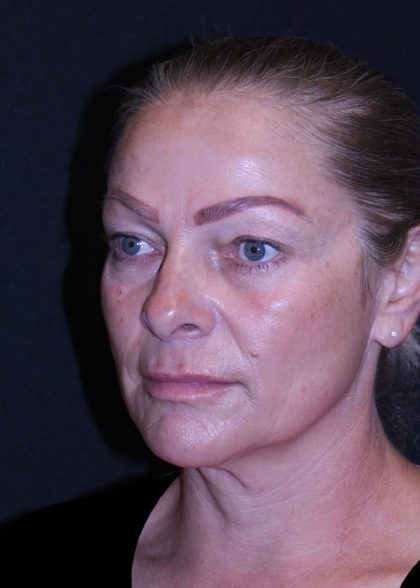 Facelift Before & After Patient #11558