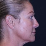 Facelift Before & After Patient #11558