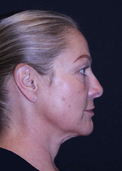 Facelift Before & After Patient #11558