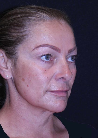 Facelift Before & After Patient #11558