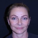 Facelift Before & After Patient #11558
