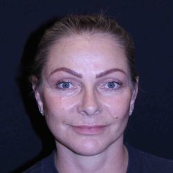 Facelift Before & After Patient #11558