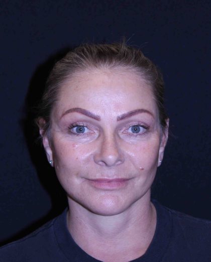 Facelift Before & After Patient #11558