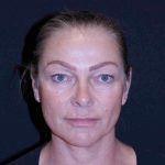 Facelift Before & After Patient #11558