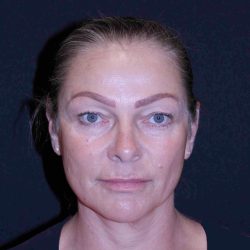 Facelift Before & After Patient #11558