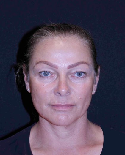 Facelift Before & After Patient #11558