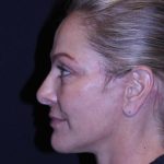 Facelift Before & After Patient #11558