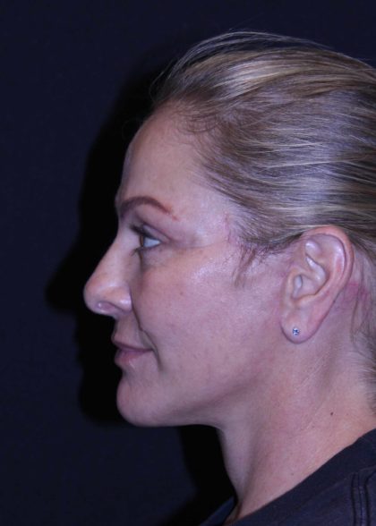 Facelift Before & After Patient #11558