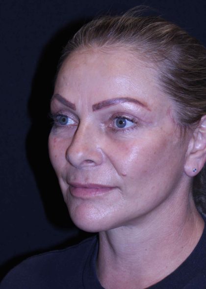 Facelift Before & After Patient #11558