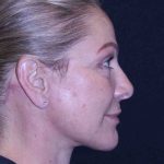 Facelift Before & After Patient #11558