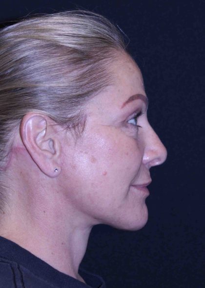 Facelift Before & After Patient #11558
