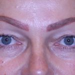 Blepharoplasty Before & After Patient #11513