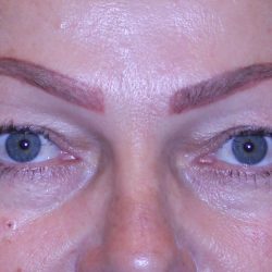 Blepharoplasty Before & After Patient #11513