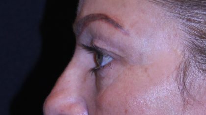 Blepharoplasty Before & After Patient #11513