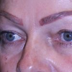 Blepharoplasty Before & After Patient #11513
