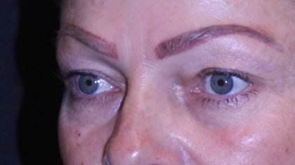 Blepharoplasty Before & After Patient #11513