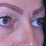 Blepharoplasty Before & After Patient #11513