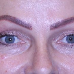 Blepharoplasty Before & After Patient #11513