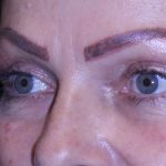 Blepharoplasty Before & After Patient #11513