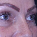 Blepharoplasty Before & After Patient #11513