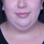 Neck Restoration Before & After Patient #11688