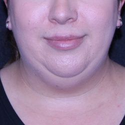 Neck Restoration Before & After Patient #11688