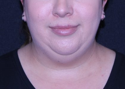 Neck Restoration Before & After Patient #11688