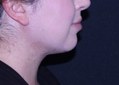Neck Restoration Before & After Patient #11688