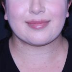 Neck Restoration Before & After Patient #11688