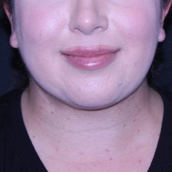 Neck Restoration Before & After Patient #11688