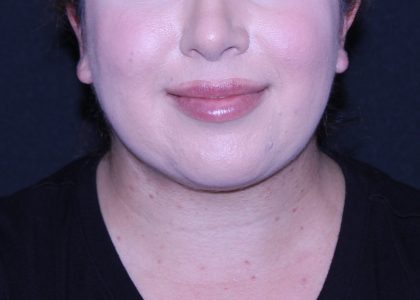 Neck Restoration Before & After Patient #11688