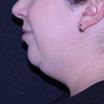 Neck Restoration Before & After Patient #11688