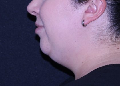 Neck Restoration Before & After Patient #11688