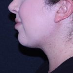 Neck Restoration Before & After Patient #11688