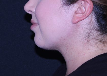 Neck Restoration Before & After Patient #11688
