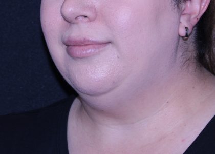 Neck Restoration Before & After Patient #11688