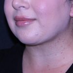 Neck Restoration Before & After Patient #11688