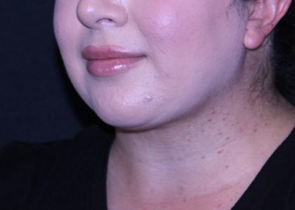 Neck Restoration Before & After Patient #11688