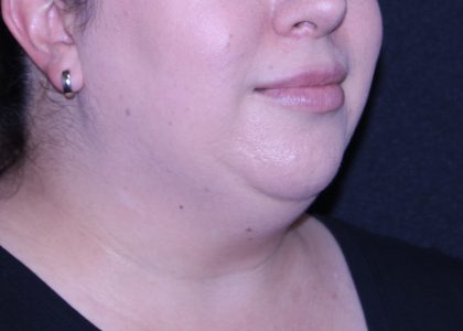 Neck Restoration Before & After Patient #11688
