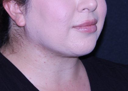 Neck Restoration Before & After Patient #11688