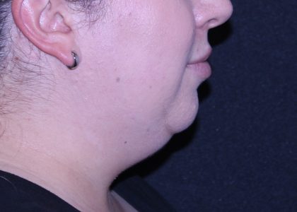 Neck Restoration Before & After Patient #11688